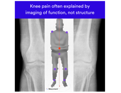 Painful Knee Without Structural Changes On MRI Benefits From 3D Imaging Of Movement