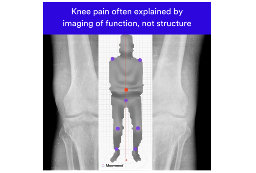 Discover the Benefits of 3D Imaging of Movement for Painful Knee